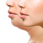 Kybella double chin removal tucson